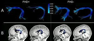 The arcuate fasciculus in a child with a family history of dyslexia (L) versus no family history (R), as seen on DTI. Image: Nicolas Langer and Barbara Peysakhovich
