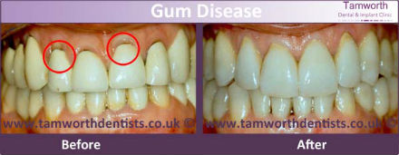 gum-disease-before-and-after-1-s