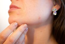 Not all acne is equal: Scientists reveal strains of acnes that promote skin health