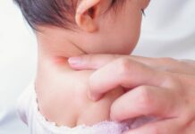 5 ways to manage childhood allergies