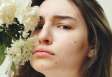 Acne spots, a stubborn reminder that you need glutathione