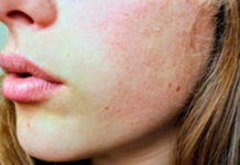 Why working professionals opting for skin boosters?