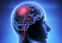 New Skin-Based Test Offers Breakthrough in Diagnosing Rare Neurodegenerative Disease