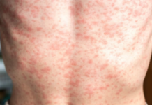 Texas Measles Outbreak Threatens U.S. Elimination Status After 25 Years
