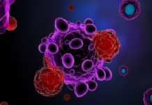 Stem Cell Therapy Found Safe and Effective for Parkinson’s Disease in Landmark Trials