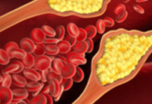 Indian Scientists Develop Optical Sensing Platform for Cholesterol Detection