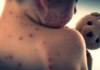 U.S. Records Highest Measles Cases in Over Three Decades