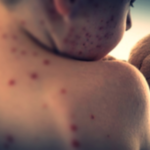 U.S. Records Highest Measles Cases in Over Three Decades