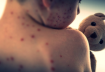 U.S. Records Highest Measles Cases in Over Three Decades