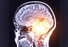 Oral and Gut Bacteria May Accelerate Parkinson’s-Related Cognitive Decline: Study