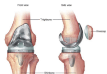 Diabetes May Increase Risk of Infection, Blood Clots After Knee Replacement: Study