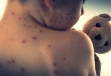 Measles Cases in the U.S. Reach Highest Level in Over 30 Years