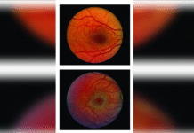 Surgical Implant Found to Slow Vision Loss in Rare Blinding Eye Disease: Study