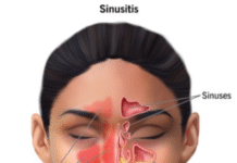 Surgery Proves More Effective than Antibiotics in Treating Chronic Sinusitis, Study Finds