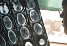 Over One-Third of Global Population Living with Brain Disorders, WHO Reports 11 Million Annual Deaths