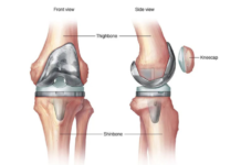 Experts Urge More Skilled Surgeons for Complex Revision Knee and Hip Surgeries in India