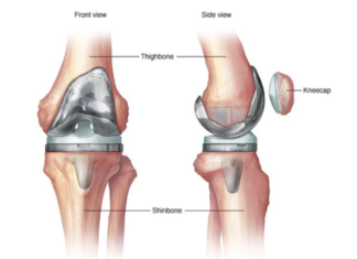Experts Urge More Skilled Surgeons for Complex Revision Knee and Hip Surgeries in India