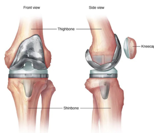 Experts Urge More Skilled Surgeons for Complex Revision Knee and Hip Surgeries in India