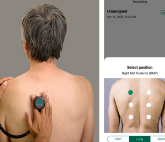 AI-Enabled Digital Stethoscopes Could Help Close Tuberculosis Screening Gaps, Study Finds